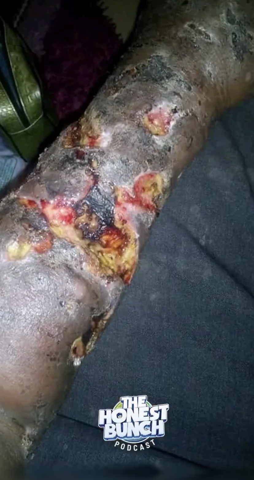 The hand of Abraham Okodugha after injecting Pentazocine