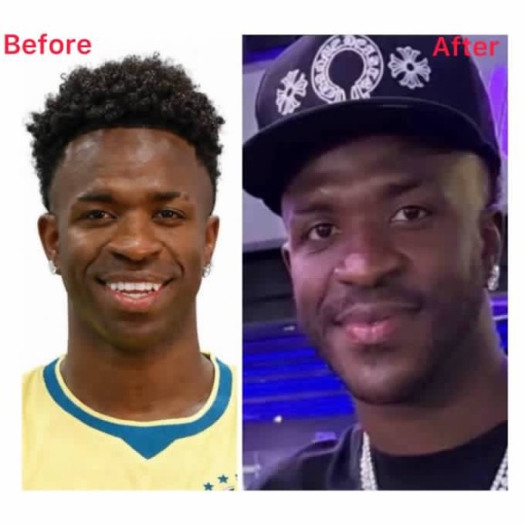 Brazil and Real Madrid star Vinicius Jr had a chin harmonization