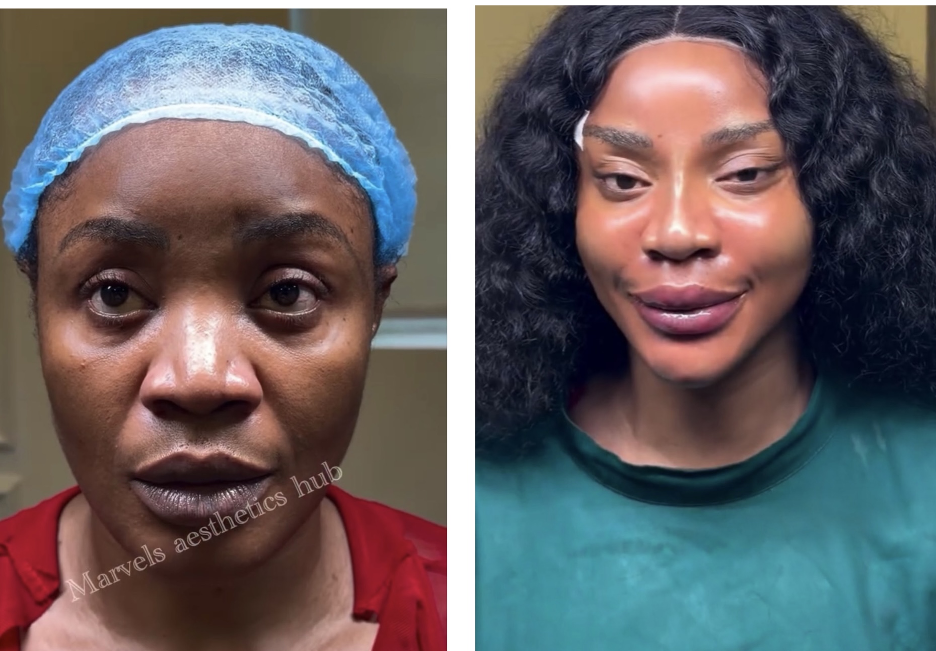 Uche Ogbodo Shows New Face After Facial Procedure